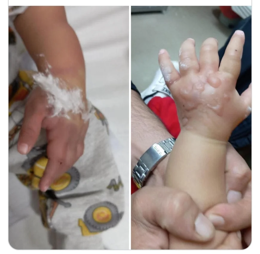 IĞDIR DEVLET  HASTANESİ'NDE ŞOK İDDİA! 1.5 YAŞINDAKİ ÇOCUĞUN KOLU, TOMOGRAFİ İLACIYLA PARÇALANDI